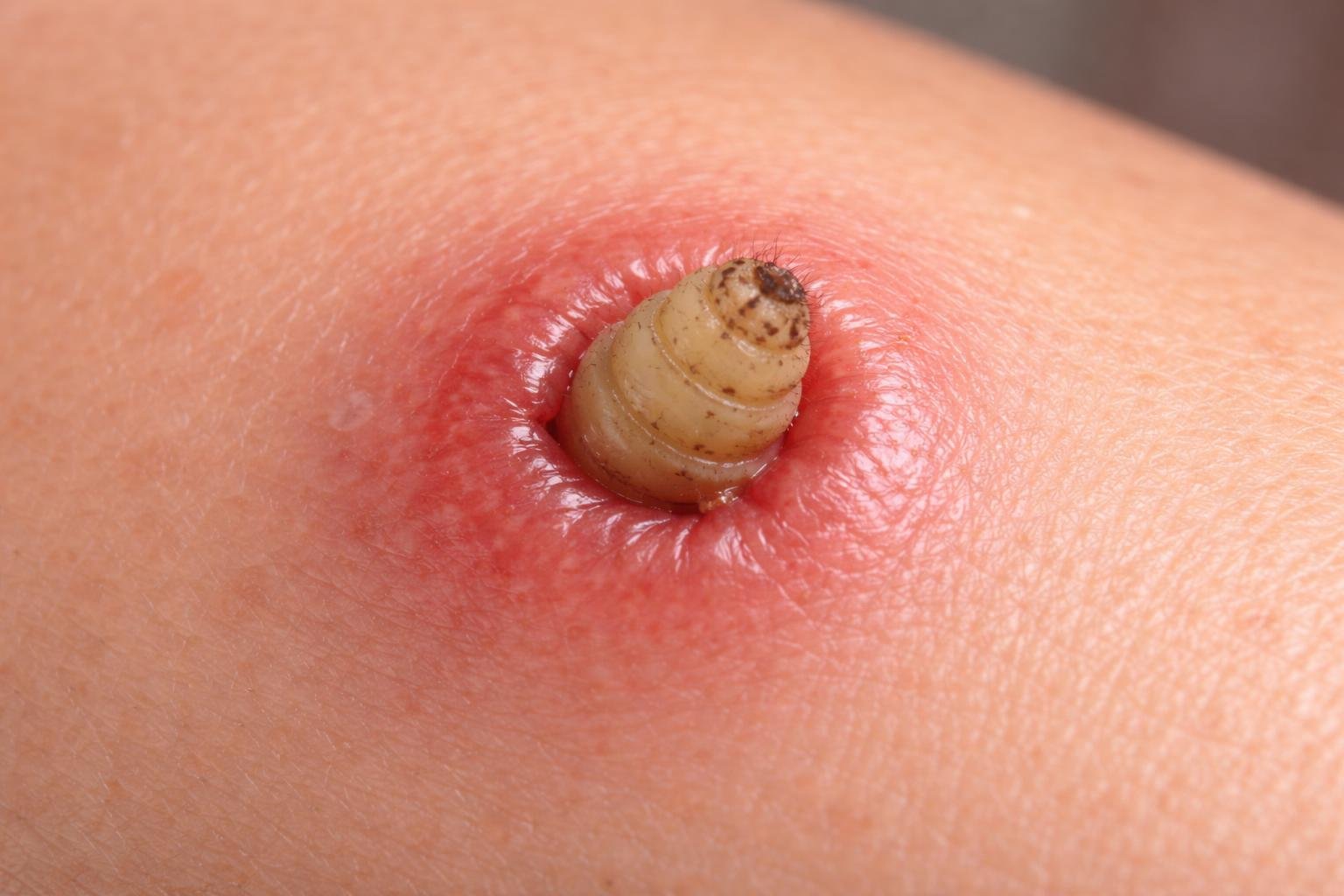 Close-up de pele humana com um pequeno berne visível sob a pele, mostrando vermelhidão ao redor.